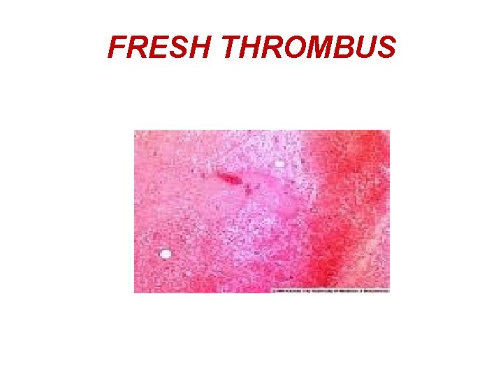 FRESH THROMBUS 