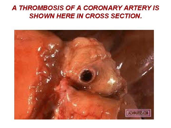 A THROMBOSIS OF A CORONARY ARTERY IS SHOWN HERE IN CROSS SECTION. 