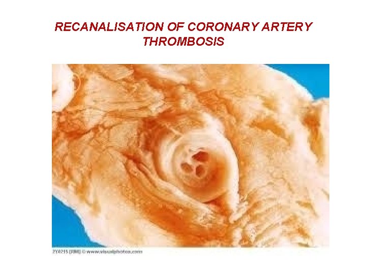 RECANALISATION OF CORONARY ARTERY THROMBOSIS 