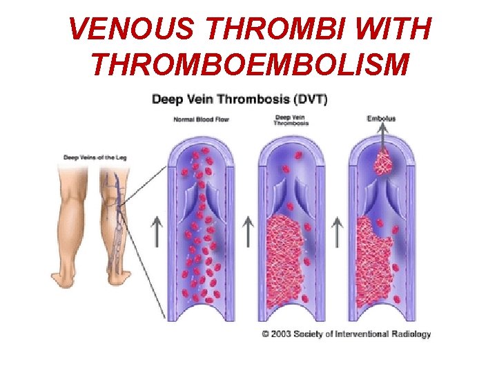 VENOUS THROMBI WITH THROMBOEMBOLISM 