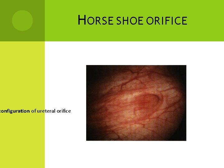 configuration of ureteral orifice H ORSE SHOE ORIFICE 