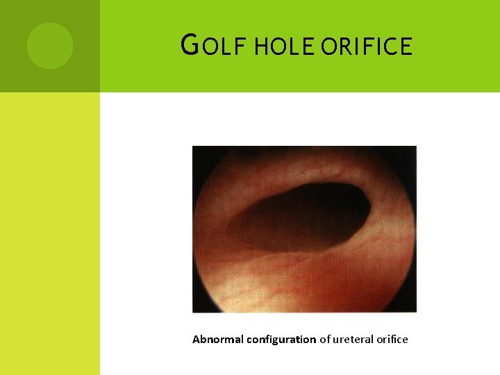 G OLF HOLE ORIFICE Abnormal configuration of ureteral orifice 