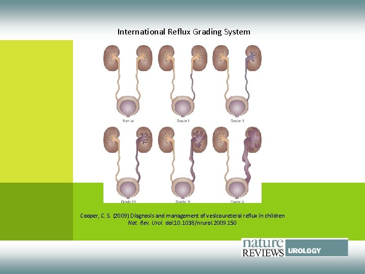 International Reflux Grading System Cooper, C. S. (2009) Diagnosis and management of vesicoureteral reflux