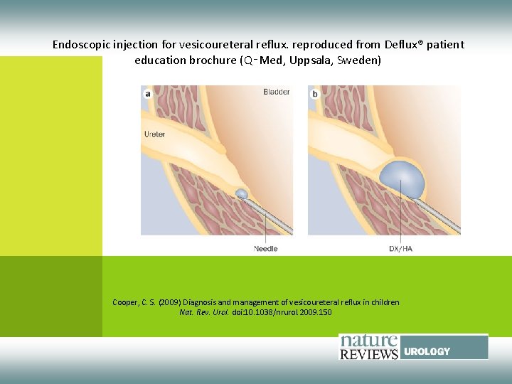 Endoscopic injection for vesicoureteral reflux. reproduced from Deflux® patient education brochure (Q‑Med, Uppsala, Sweden)