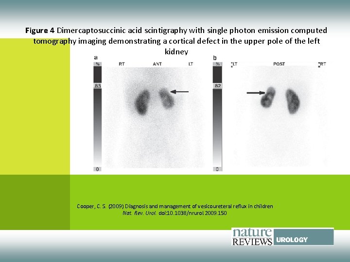 Figure 4 Dimercaptosuccinic acid scintigraphy with single photon emission computed tomography imaging demonstrating a