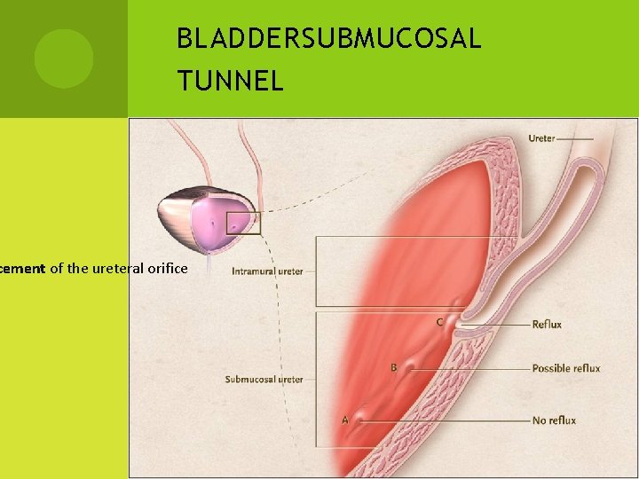 BLADDER SUBMUCOSAL TUNNEL cement of the ureteral orifice 