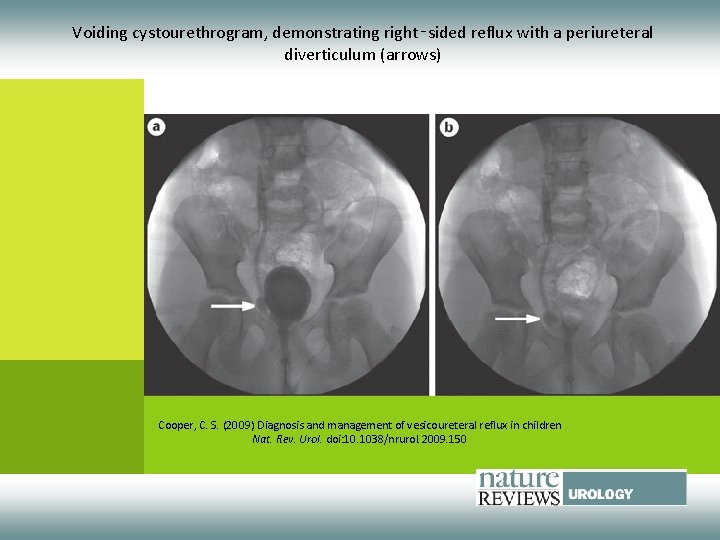 Voiding cystourethrogram, demonstrating right‑sided reflux with a periureteral diverticulum (arrows) Cooper, C. S. (2009)