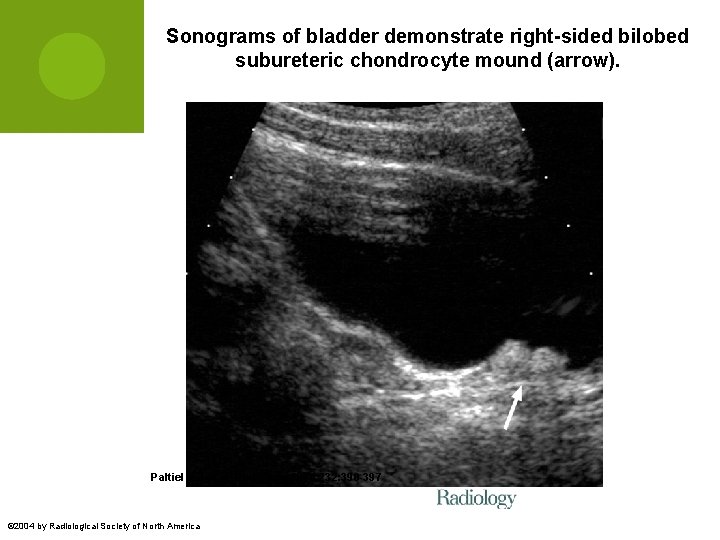 Sonograms of bladder demonstrate right-sided bilobed subureteric chondrocyte mound (arrow). Paltiel H J et