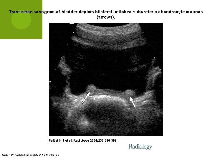 Transverse sonogram of bladder depicts bilateral unilobed subureteric chondrocyte mounds (arrows). Paltiel H J