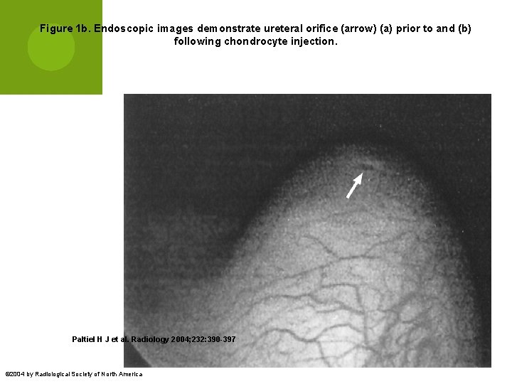 Figure 1 b. Endoscopic images demonstrate ureteral orifice (arrow) (a) prior to and (b)