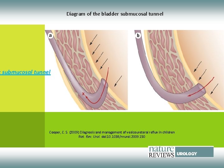Diagram of the bladder submucosal tunnel t submucosal tunnel Cooper, C. S. (2009) Diagnosis
