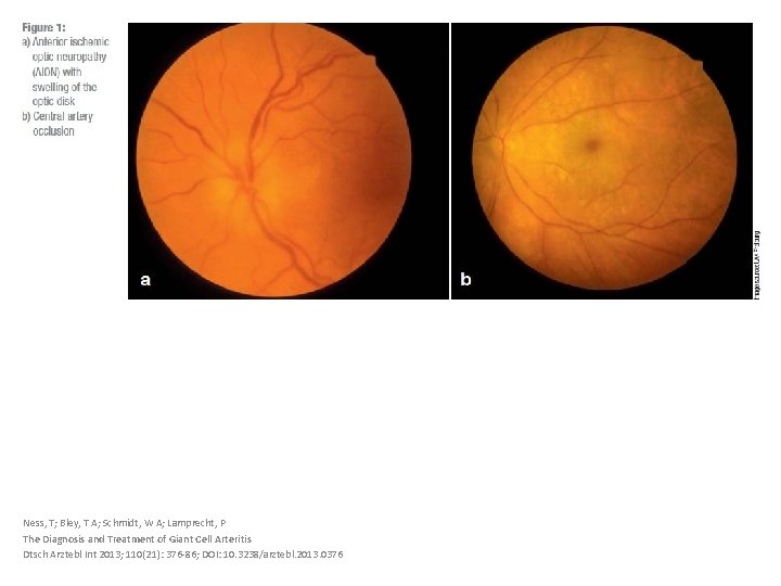 Ness, T; Bley, T A; Schmidt, W A; Lamprecht, P The Diagnosis and Treatment