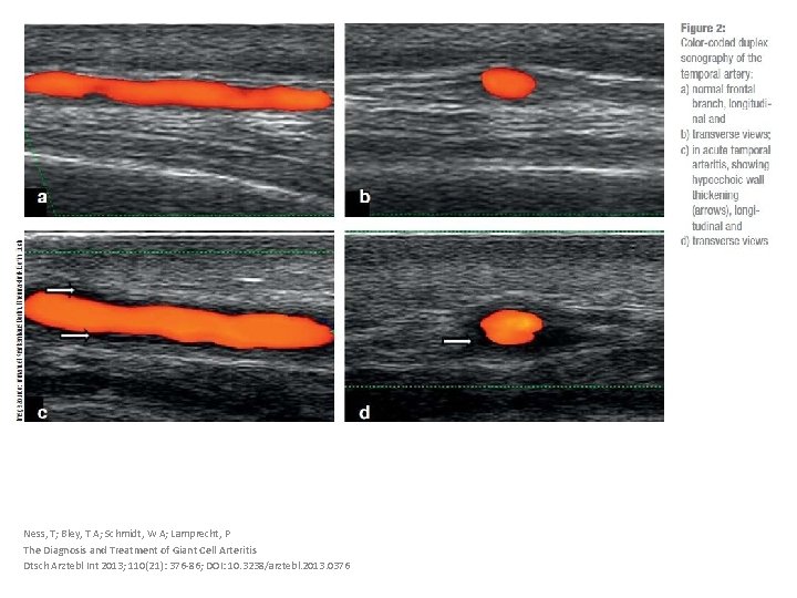 Ness, T; Bley, T A; Schmidt, W A; Lamprecht, P The Diagnosis and Treatment
