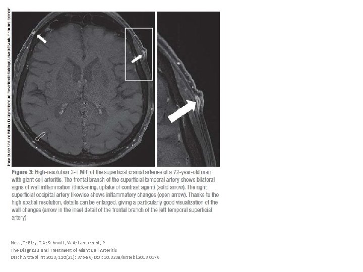 Ness, T; Bley, T A; Schmidt, W A; Lamprecht, P The Diagnosis and Treatment