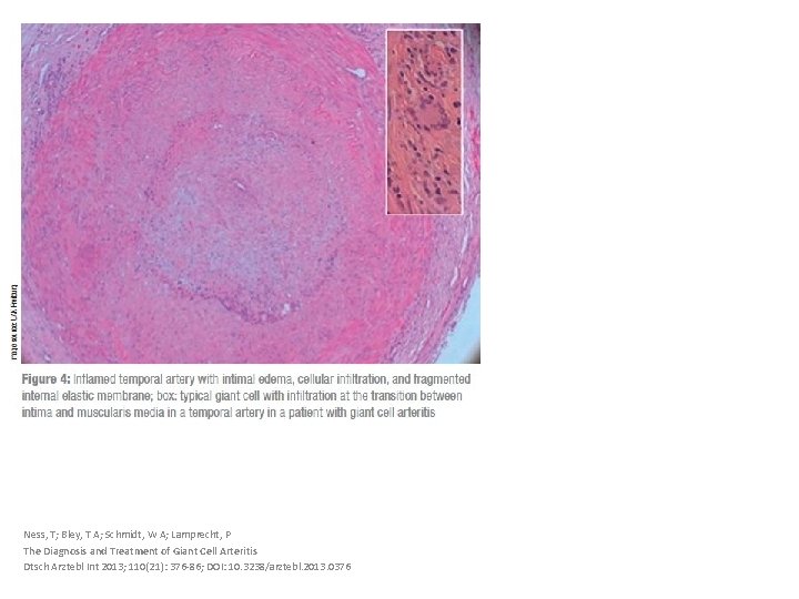 Ness, T; Bley, T A; Schmidt, W A; Lamprecht, P The Diagnosis and Treatment