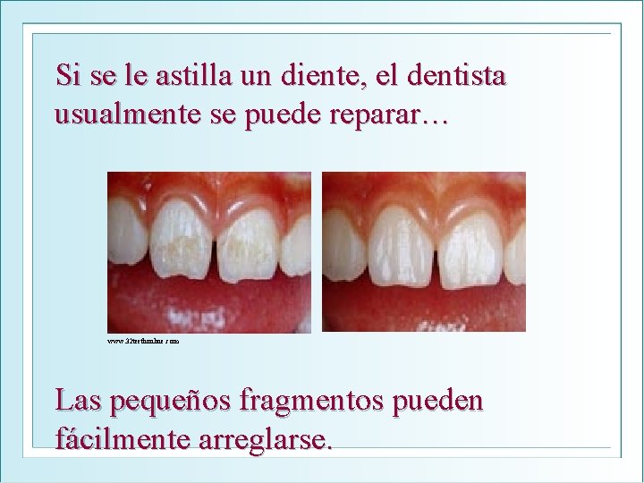 Si se le astilla un diente, el dentista usualmente se puede reparar… www. 32
