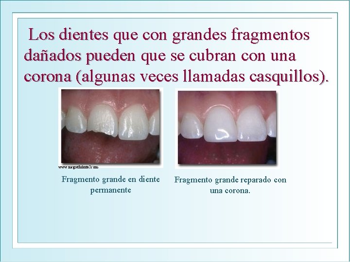 Los dientes que con grandes fragmentos dañados pueden que se cubran con una corona
