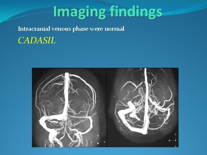 Imaging findings Intracranial venous phase were normal CADASIL 