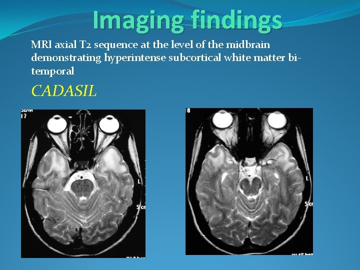 Imaging findings MRI axial T 2 sequence at the level of the midbrain demonstrating