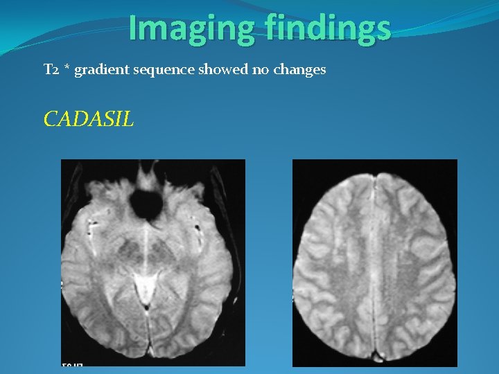 Imaging findings T 2 * gradient sequence showed no changes CADASIL 