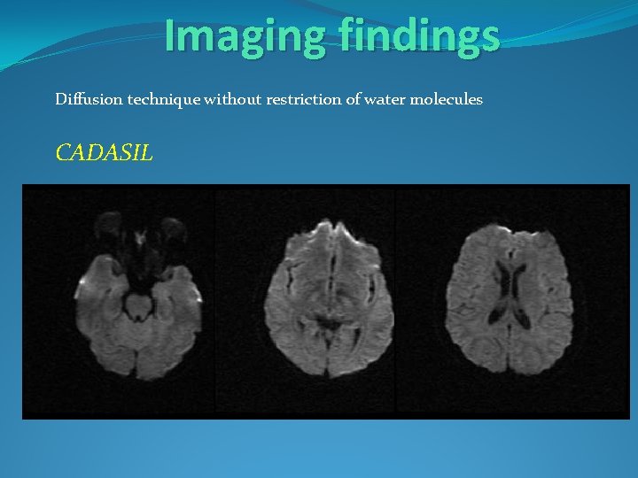 Imaging findings Diffusion technique without restriction of water molecules CADASIL 