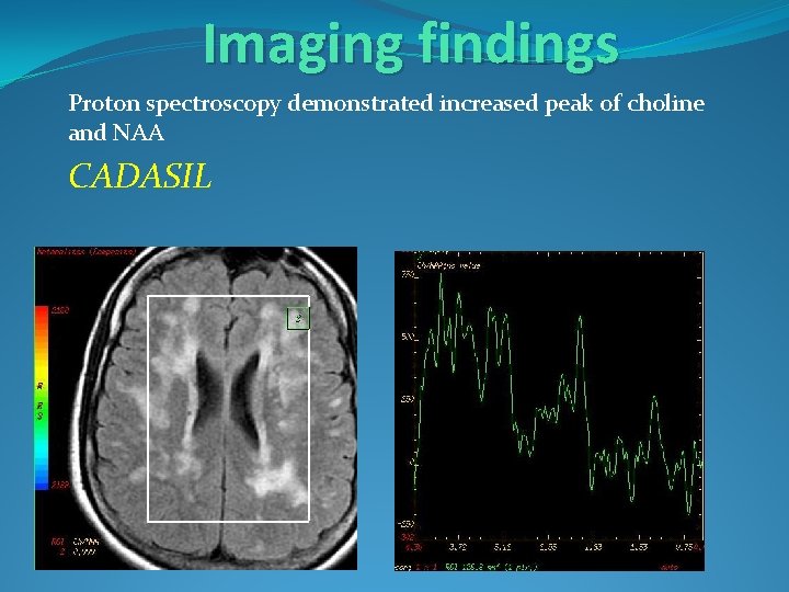 Imaging findings Proton spectroscopy demonstrated increased peak of choline and NAA CADASIL 