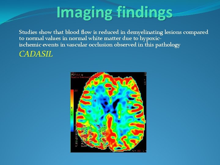 Imaging findings Studies show that blood flow is reduced in demyelinating lesions compared to