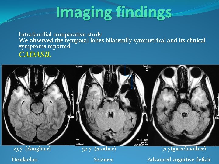 Imaging findings Intrafamilial comparative study We observed the temporal lobes bilaterally symmetrical and its