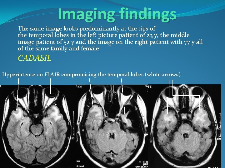 Imaging findings The same image looks predominantly at the tips of the temporal lobes