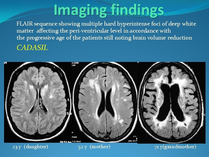 Imaging findings FLAIR sequence showing multiple hard hyperintense foci of deep white matter affecting