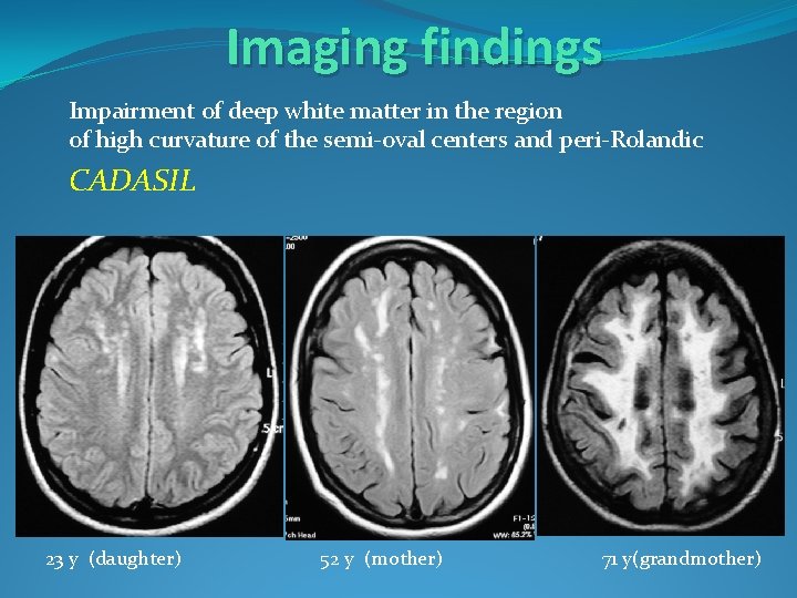 Imaging findings Impairment of deep white matter in the region of high curvature of