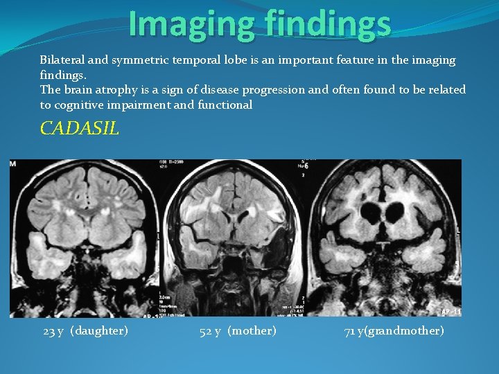 Imaging findings Bilateral and symmetric temporal lobe is an important feature in the imaging