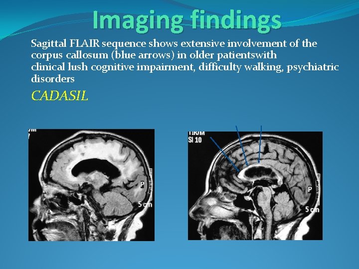 Imaging findings Sagittal FLAIR sequence shows extensive involvement of the corpus callosum (blue arrows)