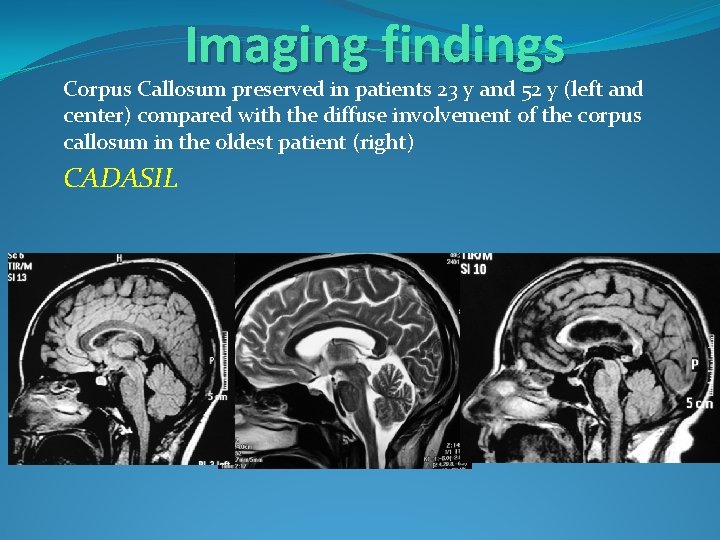 Imaging findings Corpus Callosum preserved in patients 23 y and 52 y (left and