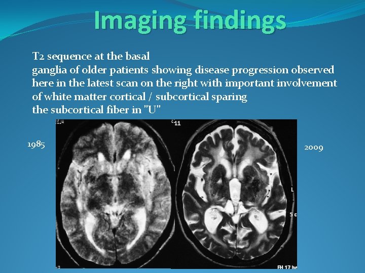 Imaging findings T 2 sequence at the basal ganglia of older patients showing disease