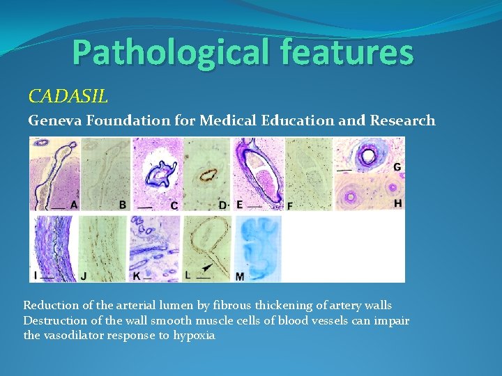 Pathological features CADASIL Geneva Foundation for Medical Education and Research Reduction of the arterial