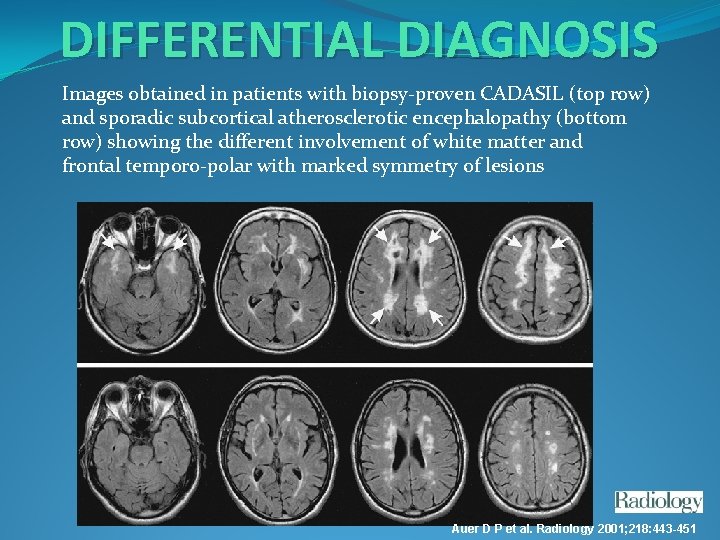 DIFFERENTIAL DIAGNOSIS Images obtained in patients with biopsy-proven CADASIL (top row) and sporadic subcortical