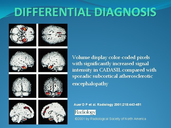 DIFFERENTIAL DIAGNOSIS Volume display color-coded pixels with significantly increased signal intensity in CADASIL compared