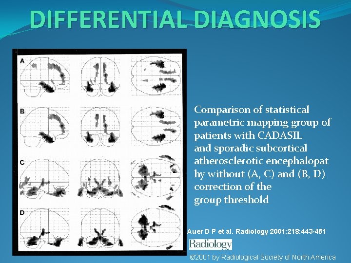 DIFFERENTIAL DIAGNOSIS Comparison of statistical parametric mapping group of patients with CADASIL and sporadic
