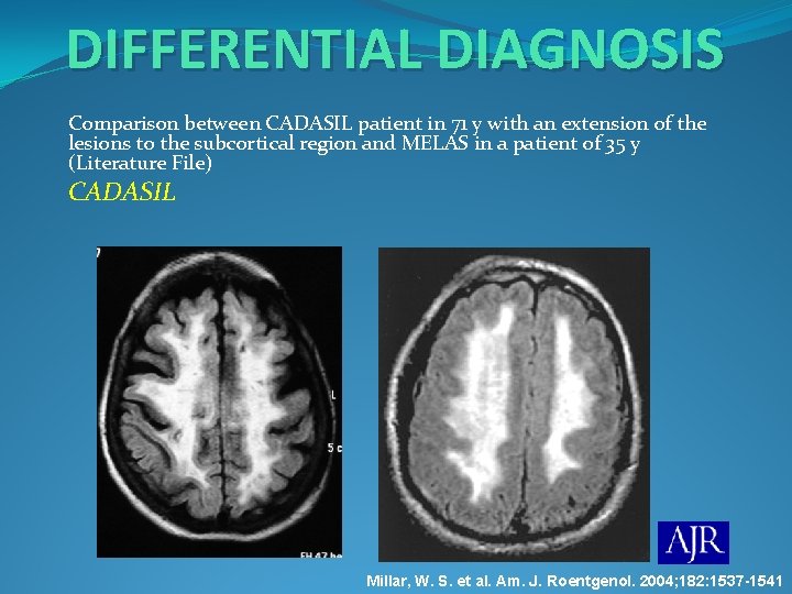 DIFFERENTIAL DIAGNOSIS Comparison between CADASIL patient in 71 y with an extension of the