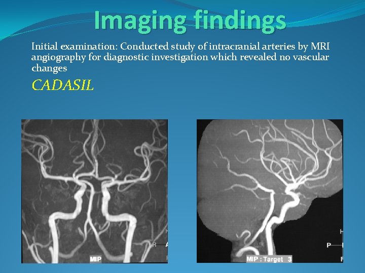 Imaging findings Initial examination: Conducted study of intracranial arteries by MRI angiography for diagnostic