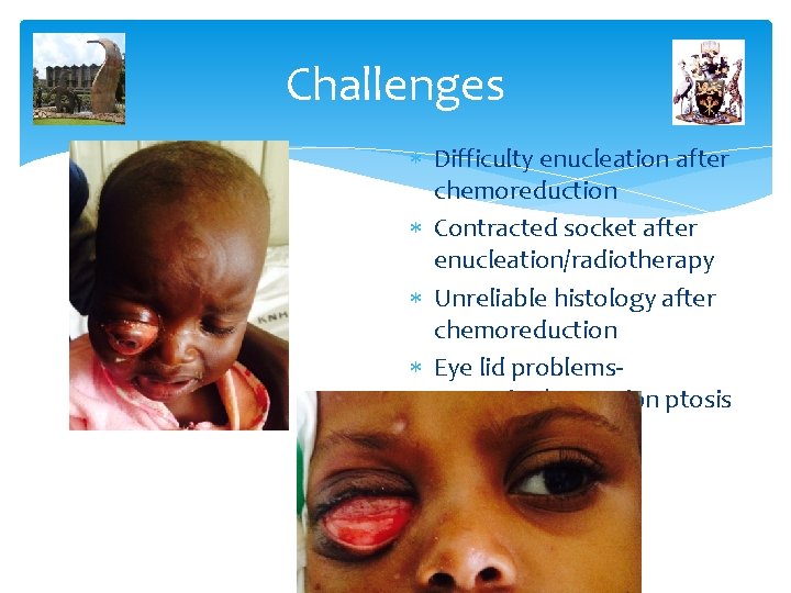 Challenges Difficulty enucleation after chemoreduction Contracted socket after enucleation/radiotherapy Unreliable histology after chemoreduction Eye