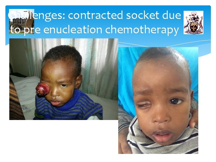 Challenges: contracted socket due to pre enucleation chemotherapy 