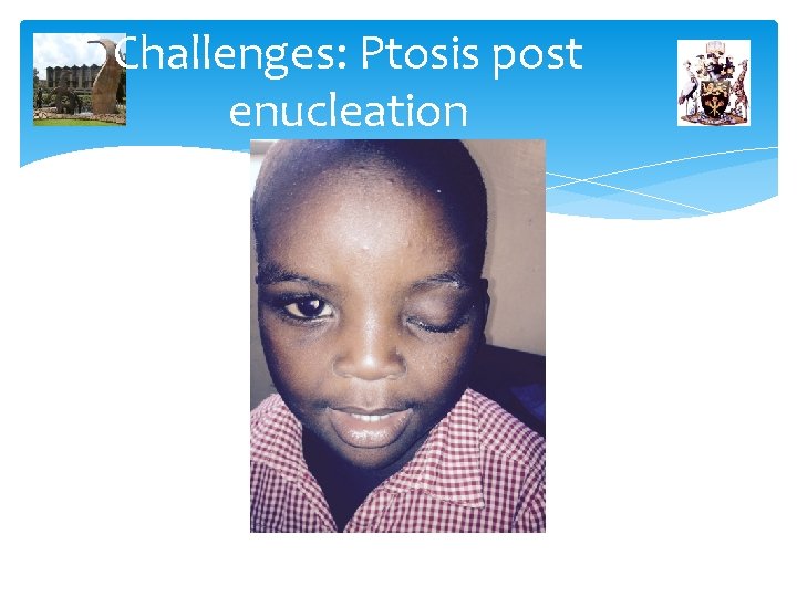 Challenges: Ptosis post enucleation 