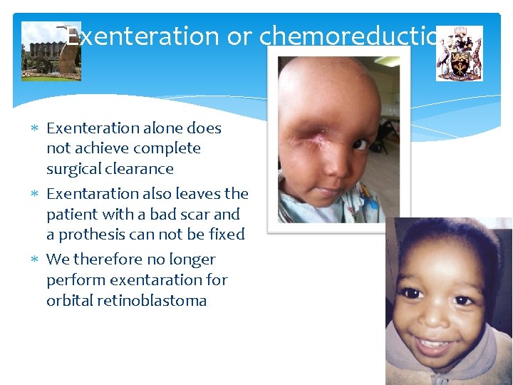 Exenteration or chemoreduction Exenteration alone does not achieve complete surgical clearance Exentaration also leaves