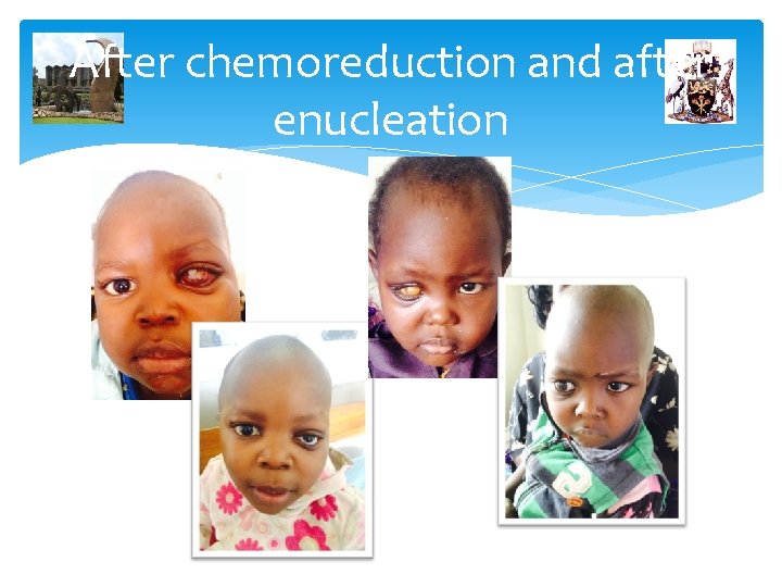 After chemoreduction and after enucleation 