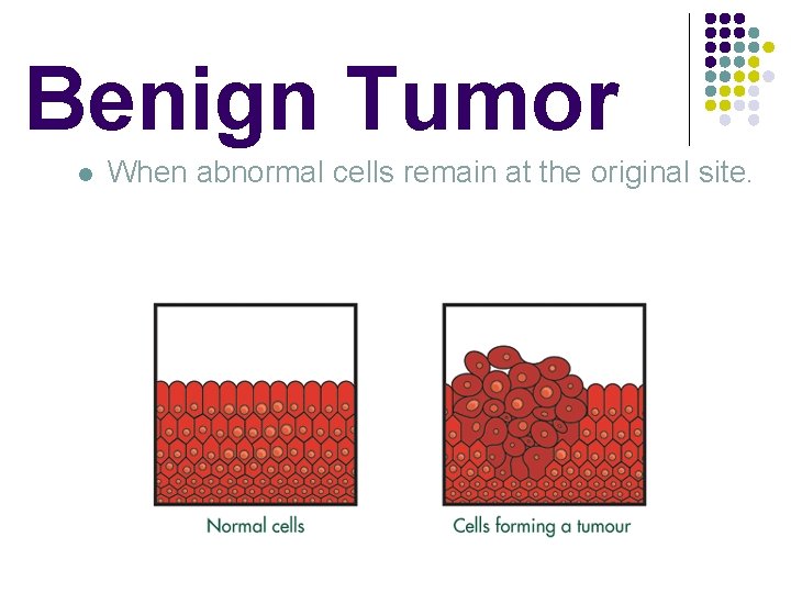 Benign Tumor l When abnormal cells remain at the original site. 