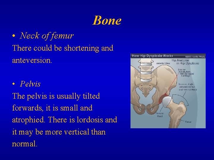 Bone • Neck of femur There could be shortening and anteversion. • Pelvis The