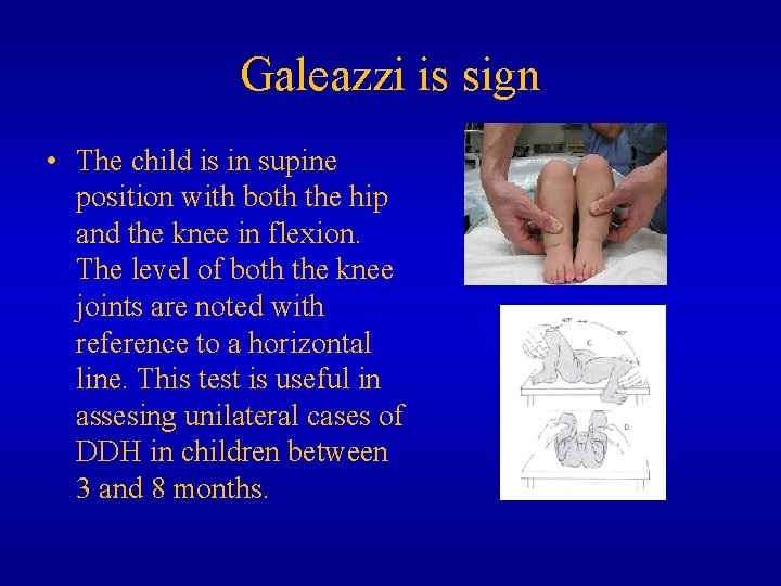 Galeazzi is sign • The child is in supine position with both the hip