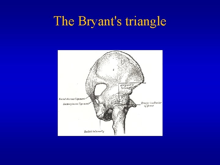 The Bryant's triangle 